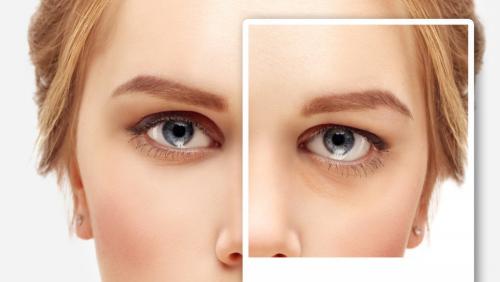 Szemhéjplasztika fiatal korban? Mikor érdemes beavatkozni esztétikai vagy egészségügyi okból